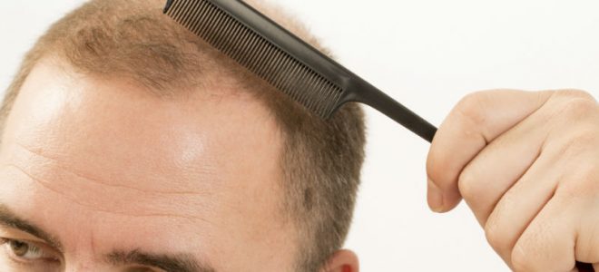 What Should Consumers Understand About Getting Hair Restoration in NYC