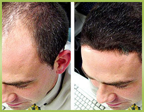 Causes For Your Hair Loss And Restoration Methods, Including FUE Transplants