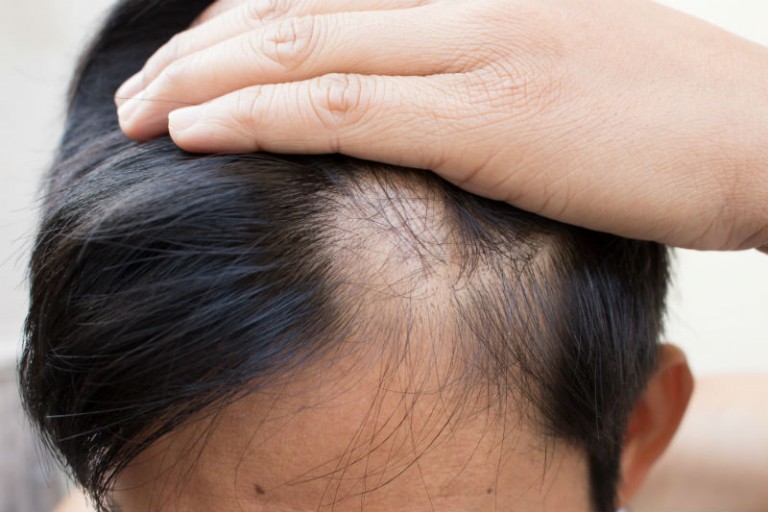 Reviving Your Crowning Glory: The Art of Hair Restoration in CT