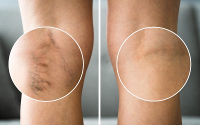 Information About Laser Vein Treatment In New York